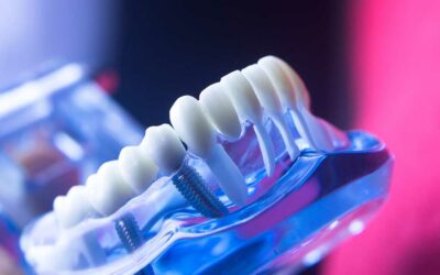 Digital Dental Prostheses: Precision, Customization, and Innovation with XDental